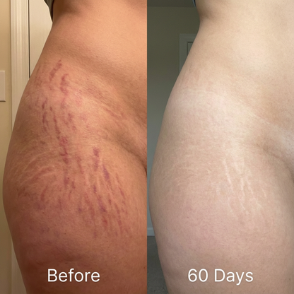 Velony™ Scar Solutions Silicone Stick