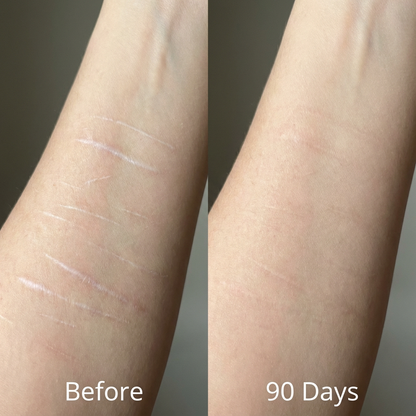 Velony™ Scar Solutions Silicone Stick