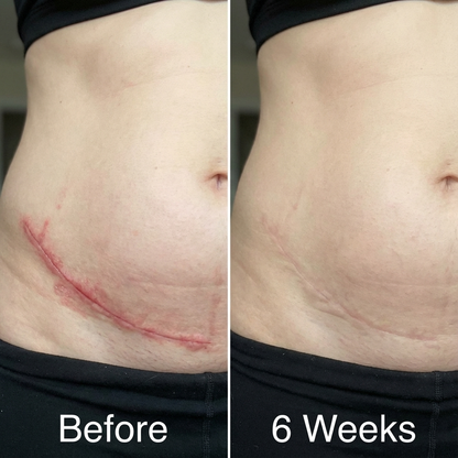 Velony™ Scar Solutions Silicone Stick