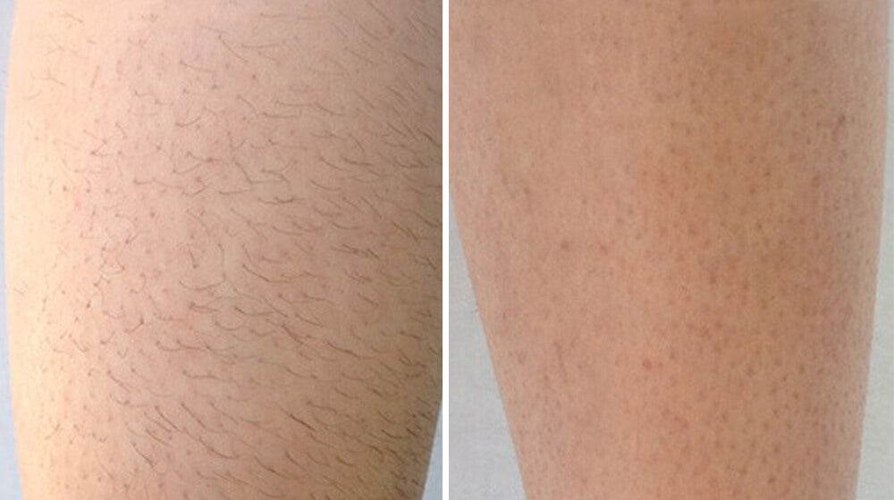 Velony Hair Removal Mousse